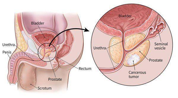 PSA-Test zur Früherkennung von Prostatakrebs