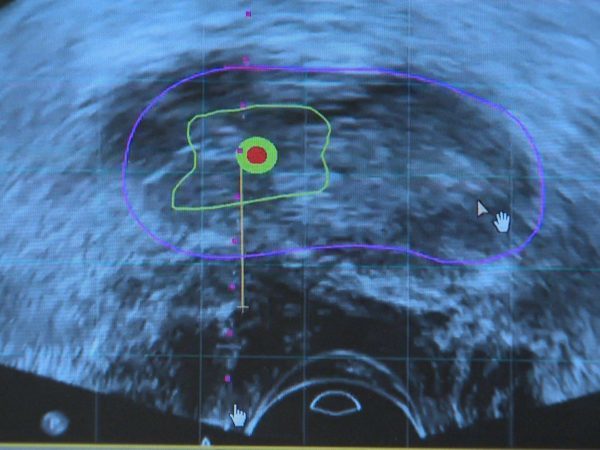 Ultraschall zur Früherkennung von Prostatakrebs